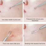 Kit De 4 Anti Acné Extractor De Puntos Negros Y Espinillas - Imagen 5